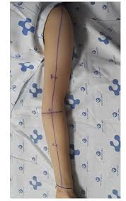 Ultrasonographic Evaluation Of Breast Cancer Related Lymphedema Protocol Translated To Turkish