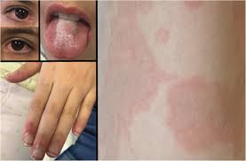 Image result for Multisystem Inflammatory Syndrome