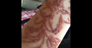 Artmasters bringt kreative events in die restaurants deiner stadt. Furchtbare Blasen Die Unbekannten Gefahren Von Henna Tattoos Welt Scoopnest