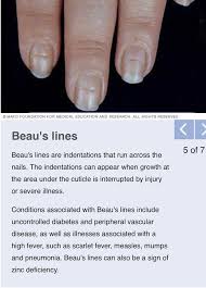 What Is The Meaning Of White Spots On Someone S Fingernails Quora