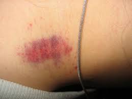 Easy Ways To Get Rid Of Hickeys Overnight How To Hide Hickeys Hickeys Bruises