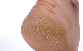 Xerosis cutis refers to abnormally dry skin. Safety Shoes Against Xerosis Cutis Safety Shoes Today