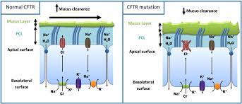 Cystic Fibrosis What Are The Prospects For A Cure European Journal Of Internal Medicine
