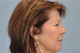 Lip Augmentation/Enhancement Before and After Photos by Paul Vanek, MD,  FACS; Concord, OH