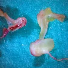 If medical treatment proves unsuccessful, your doctor may recommend that you have your nasal polyps removed surgically. Pdf Bilateral Antrochoanal Polyp In An Adult A Rarity