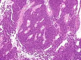 Image result for Glomus tumor