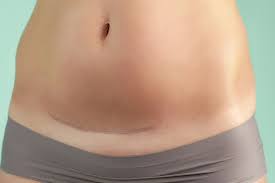 Wann ist ein kaiserschnitt besser als eine natürliche geburt? Infos Uber Den Kaiserschnitt Bauch De