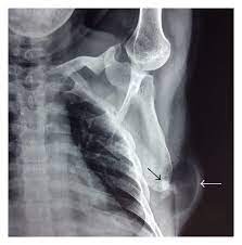 We did not find results for: Lump On Back A Rare Case Of Parosteal Lipoma Of Scapula