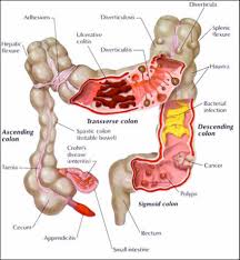Colon cancer is sometimes called colorectal cancer, which is a term that combines colon cancer and rectal cancer, which begins in the rectum. Colonoscopy Test For Colon Problems Early Detection Of Bowel Cancer