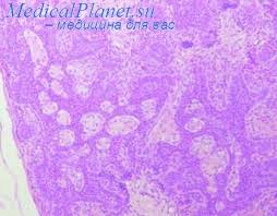 Круглые элементы со слегка зернистой поверхностью и точечным углублением в центре (проток сальной железы), размером от 2 мм до 1 см. Epitelioma Salnyh Zhelez Rak Salnyh Zhelez