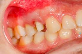 However, before you know how to treat this oral health condition it's very reasonable to have a customary fast of 12 hours or more with nothing but plentiful water consumption. What You Need To Know About Periodontal Disease Rigby Dental