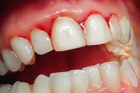 We did not find results for: Waarom Je Bloedend Tandvlees Nooit Mag Negeren