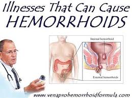 Pin On Hemorrhoid Articles