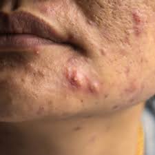 Image result for acne face