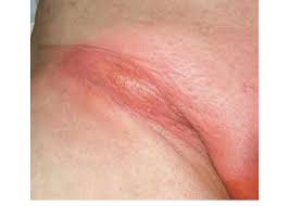 Image result for sore skin in the groin area