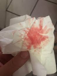 Signs of a miscarriage include vaginal spotting, abdominal pain, cramping, and fluid, blood clots, and tissue passing from the vagina. Miscarriage Or Normal Spotting Help February 2020 Babies Forums What To Expect