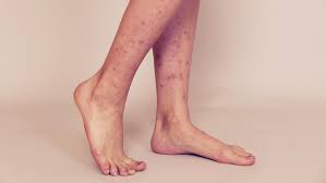 Image result for liver spots on legs