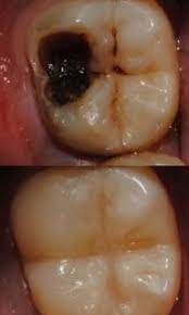 If I Don T See A Hole Cavity In My Mouth Do I Have To Get It Filled Technically You Don T Have To Do Anything How Dental Care Dental Family Dentist