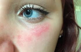 Vidy Allergii Na Lice Lechenie Allergii Almaty