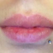 Lippenrand Rot Lippe Brennen
