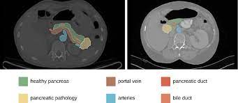 Prediction of clinically relevant postoperative pancreatic fistula using  radiomic features and preoperative data | Scientific Reports