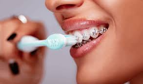 If you just got braces, you're probably wondering how to get rid of braces pain. How To Care For Your Mouth If You Have Braces From Bonjela