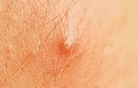 As hair grows, sometimes it takes an unexpected detour and begins growing removing ingrown hair. How To Prevent Ingrown Hair 11 Practical Tips Grooming Essentials Blog Grooming Tips For Men And Women