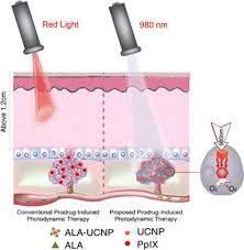 Exciting New Light Therapy Kills Deep Cancers With No Toxic Side Effects Ciencia