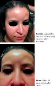 Figure 2 from Frontal edema after application of 5% minoxidil and biotin in  intradermal injections