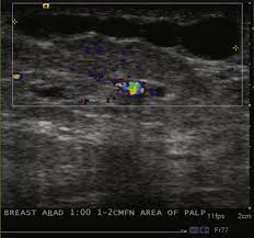 Penile mondor's disease is one manifestation of mondor's disease, a condition first described by mondor's disease is characterized by thrombophlebitis of the chest wall and breast that can also. 145 Clinical Gate