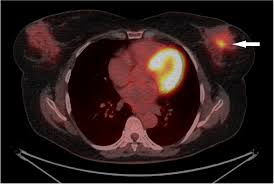 Unfortunately, unlike mammography for breast cancer, there is currently no screening test that has been proven to reduce. Transverse Image Of 18 F Fdg Pet Ct In Patient With Breast Cancer Download Scientific Diagram