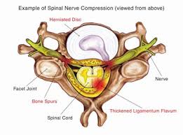Check spelling or type a new query. Pinched Nerves Can Cause Back And Neck Pain