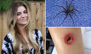 So it must be a spider bite, right? Monster Spider Bites Leaves Woman Suffering Months Of Agony Uk News Express Co Uk