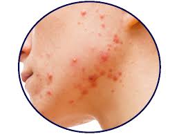 This innovative treatment gel has been specially formulated to reduce the appearance of pimples, papules, and pustules as well as to fade acne marks. Best Skin Care In Malaysia Best Acne Cleanser Malaysia