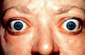 Patients often first notice weakness in the muscles that control the movement of their eyes and eyelids. Graves Disease Wikipedia