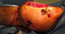 A 0.50 caliber bullet wound of the face. Gunshot Wound Wikipedia