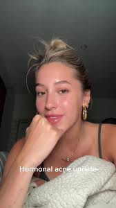 My Hormonal Acne Journey: Skin Update and Remedies