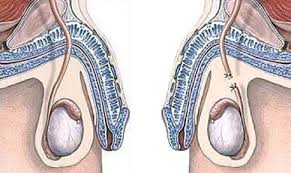 Vasectomia En Malaga Tratamiento Urologico