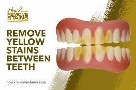 How to remove yellow spots (foxing stains). How To Remove Yellow Stains Between Teeth Detailed Answer