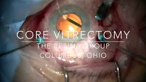 After the retinal detachment surgery there are several do's and don'ts that most people have to follow for a period of a few weeks. Surgery Information The Retina Group