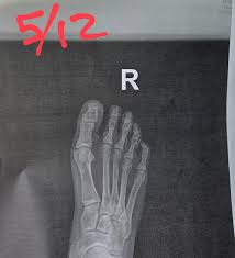 Image result for Osteomyelitis XRay