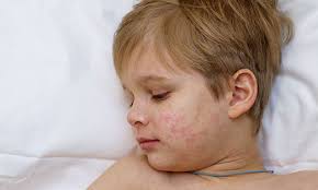 Image result for shingles in children