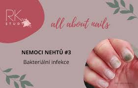 Image result for Akutní zánět nehtového lůžka