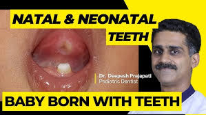 Image result for Neonatal Teeth