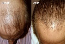 11 my brother has long/big hair. Men S Hair Loss Treatments And Solutions With Pictures