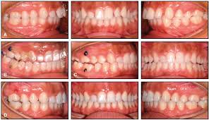 3 doctor answers • 4 doctors weighed in. Creative Adjuncts For Clear Aligners Part 1 Class Ii Treatment Jco Online Journal Of Clinical Orthodontics