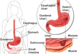 What a stomach ulcer looks like you have a peptic ulcer if you get open sores in the lining of your stomach or the upper part of the small intestine. Peptic Ulcer Symptoms In Women Stomach Ulcers Peptic Ulcer Ulcer Symptoms