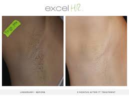 The trick is to set realistic expectations, talk to an expert before starting treatment, and know what to expect before, during, and after. Laser Hair Removal Interlocks Salon Medspa Wellness Newburyport Ma