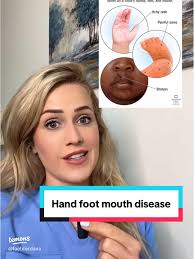 Identifying RA Triggers in Hands and Feet: My Personal Experience