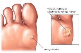Cómo quitar las durezas de los pies? | Blog